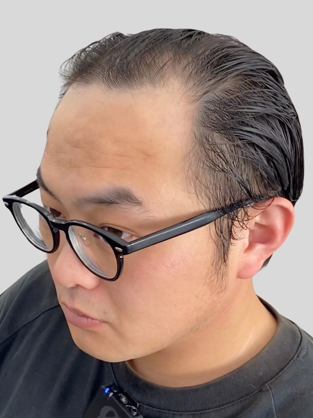 創業者の男性ウィッグ装着前の生え際と横顔