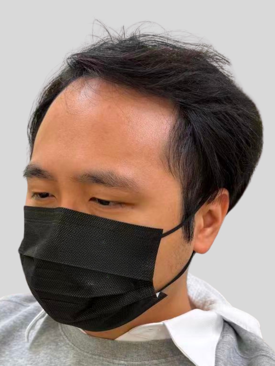 男性ウィッグ装着前の前髪と横顔