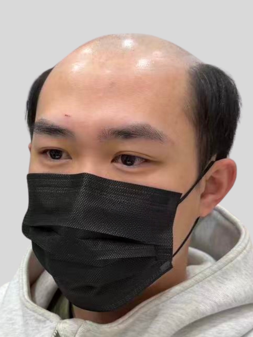 男性ウィッグ装着前の前髪と頭頂部